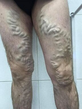 novārtā atstātas vīriešu varikozas vēnas