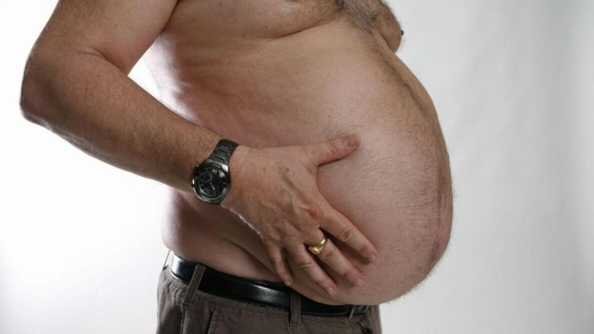 aptaukošanās kā varikozu vēnu attīstības cēlonis
