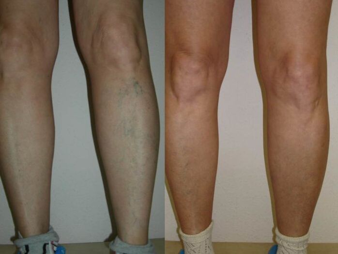 kājas pirms un pēc varikozu vēnu lāzerterapijas