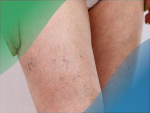 Asinsvadu tīkls uz kājām ir viens no varikozu vēnu simptomiem