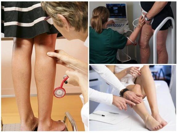 Varikozu vēnu diagnoze