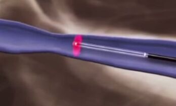 Termiskās procedūras